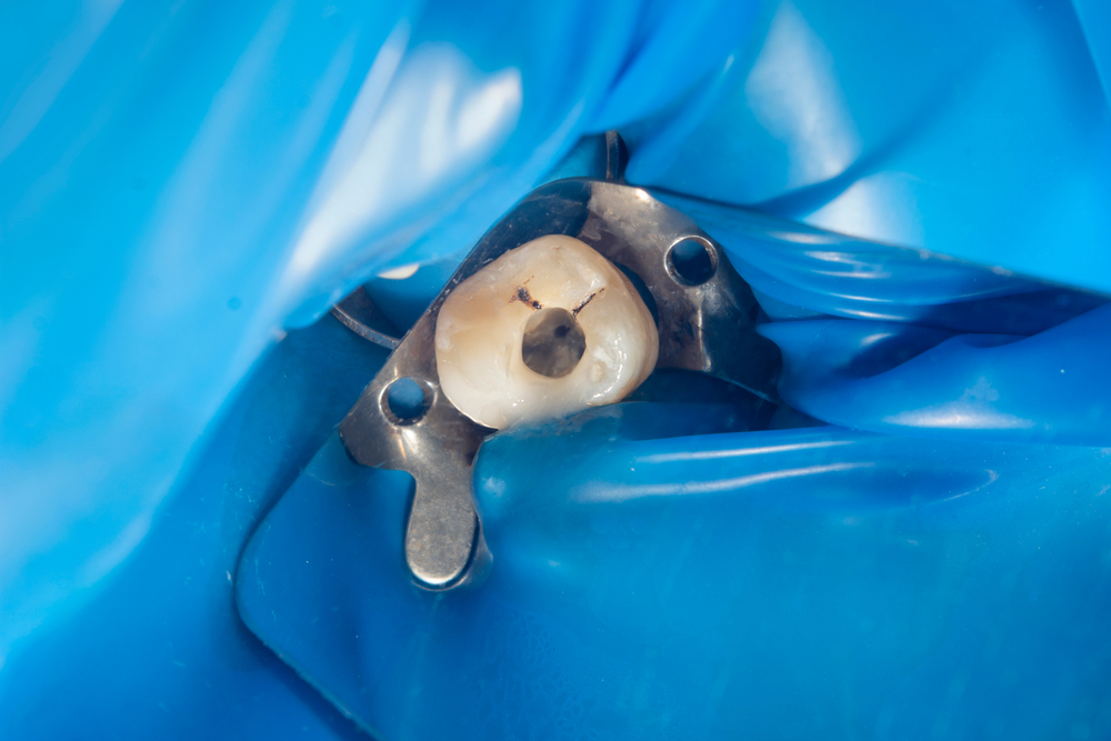 Root Canal Therapy Stockton