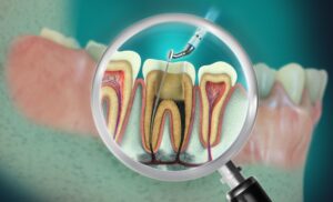Endodontics Stockton