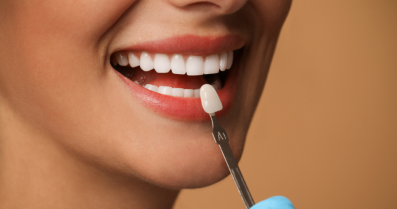 Dental Veneers in Stockton